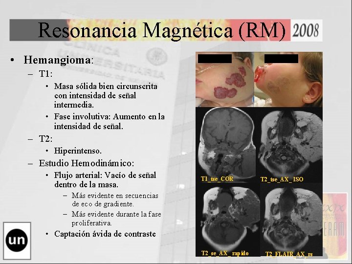 Resonancia Magnética (RM) • Hemangioma: – T 1: • Masa sólida bien circunscrita con