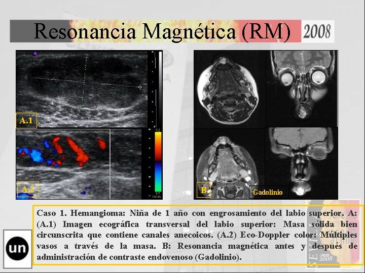 Resonancia Magnética (RM) A. 1 A. 2 B Gadolinio Caso 1. Hemangioma: Niña de