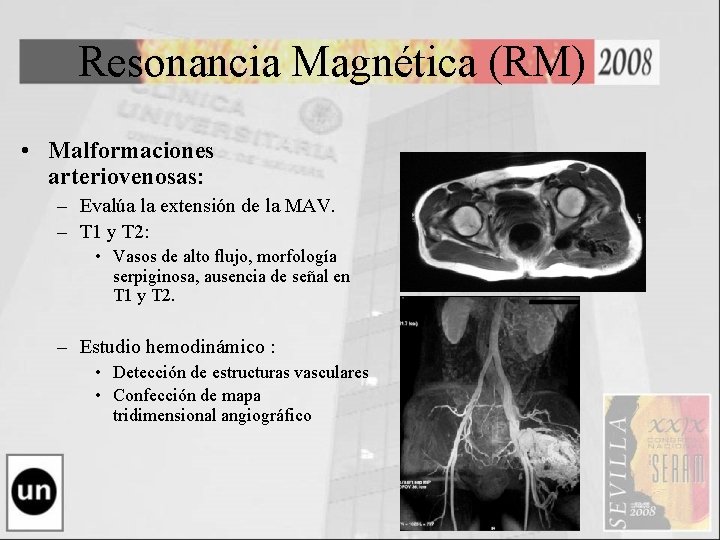 Resonancia Magnética (RM) • Malformaciones arteriovenosas: – Evalúa la extensión de la MAV. –