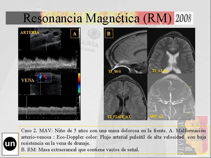 Resonancia Magnética (RM) ARTERIA A B T 1_SAG T 2_AX_iso VENA T 2_FLAIR_AX MIP_AX