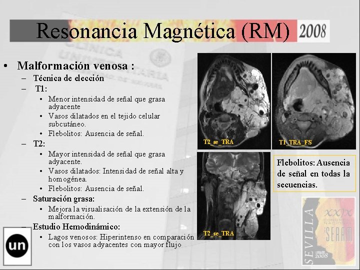 Resonancia Magnética (RM) • Malformación venosa : – Técnica de elección – T 1: