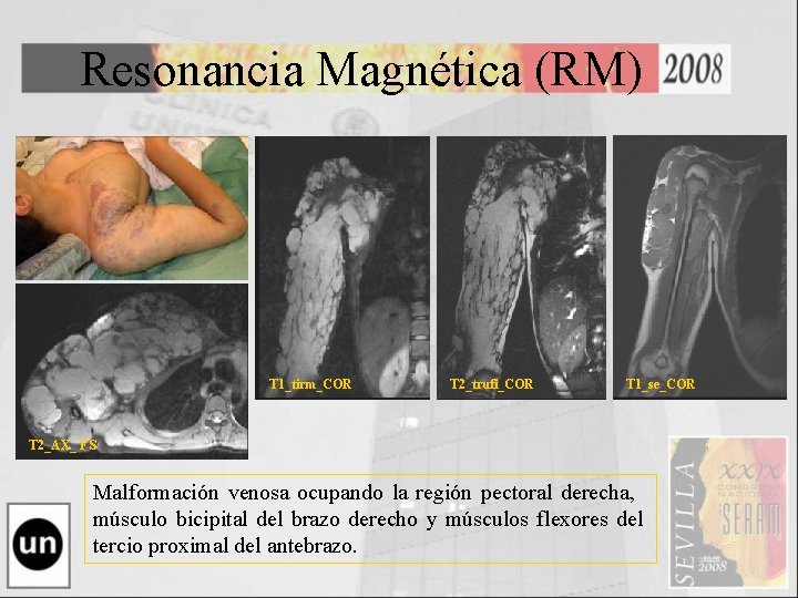 Resonancia Magnética (RM) T 1_tirm_COR T 2_trufi_COR T 1_se_COR T 2_AX_ FS Malformación venosa