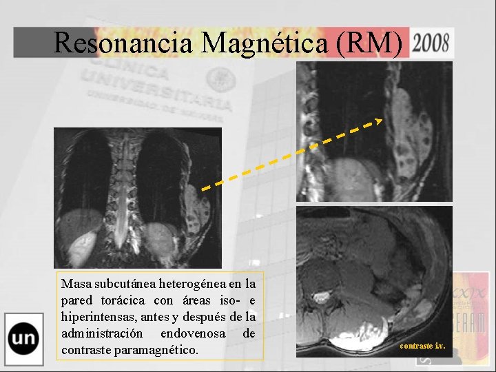 Resonancia Magnética (RM) Masa subcutánea heterogénea en la pared torácica con áreas iso- e