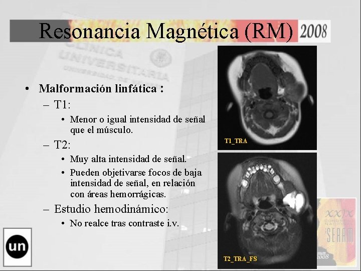 Resonancia Magnética (RM) • Malformación linfática : – T 1: • Menor o igual