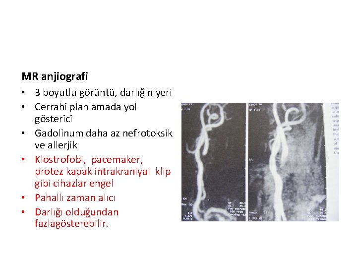 MR anjiografi • 3 boyutlu görüntü, darlığın yeri • Cerrahi planlamada yol gösterici •