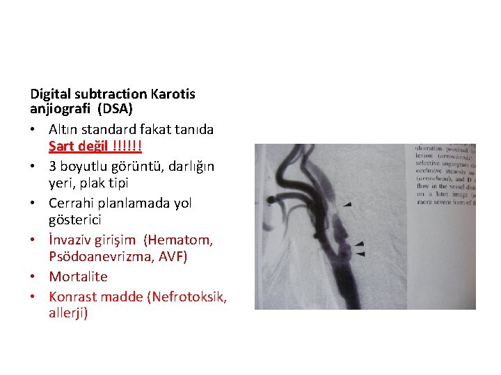 Digital subtraction Karotis anjiografi (DSA) • Altın standard fakat tanıda Şart değil !!!!!! •