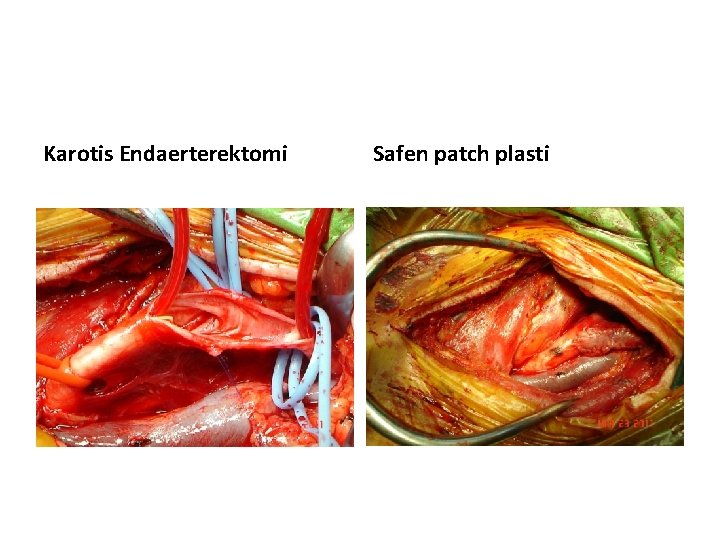 Karotis Endaerterektomi Safen patch plasti 