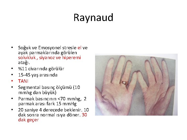 Raynaud • Soğuk ve Emosyonel stresle el ve ayak parmaklarında görülen solukluk , siyanoz