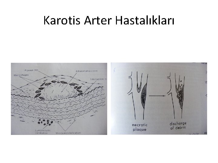 Karotis Arter Hastalıkları 