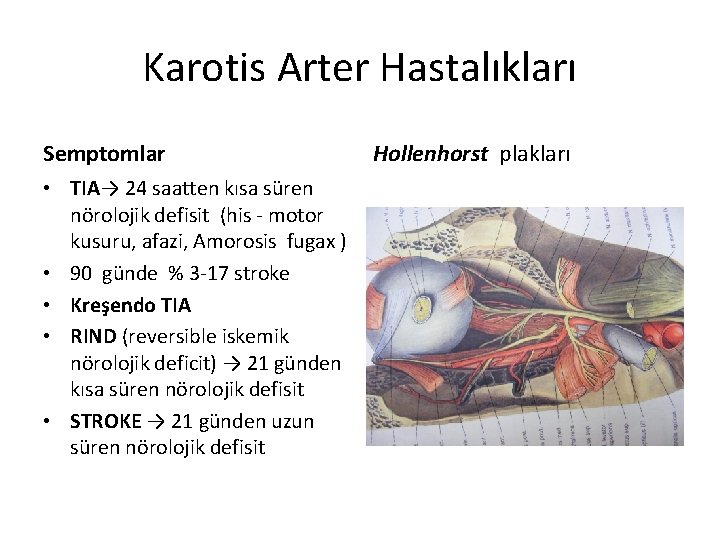 Karotis Arter Hastalıkları Semptomlar • TIA→ 24 saatten kısa süren nörolojik defisit (his -