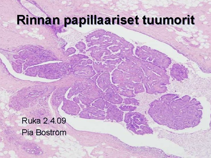 Rinnan papillaariset tuumorit Ruka 2. 4. 09 Pia Boström 