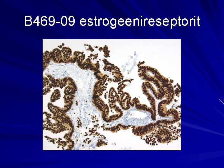 B 469 -09 estrogeenireseptorit 