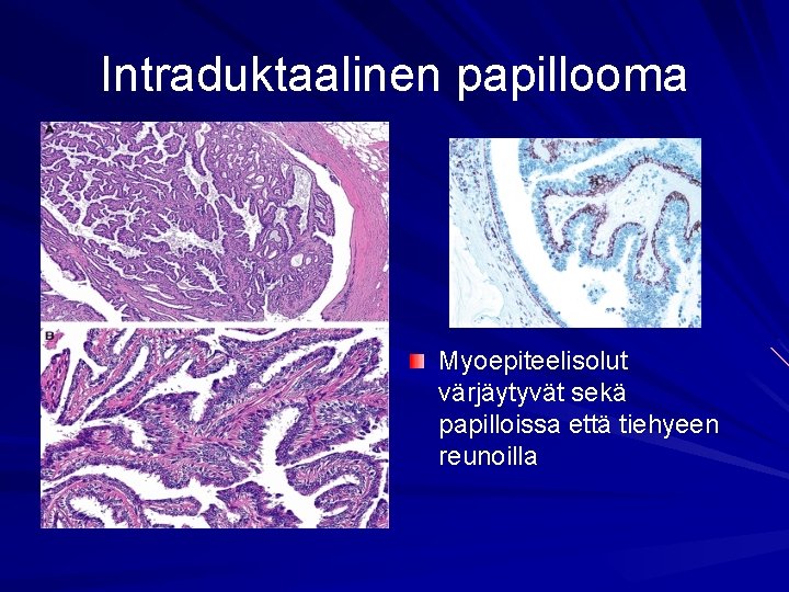 Intraduktaalinen papillooma Myoepiteelisolut värjäytyvät sekä papilloissa että tiehyeen reunoilla 