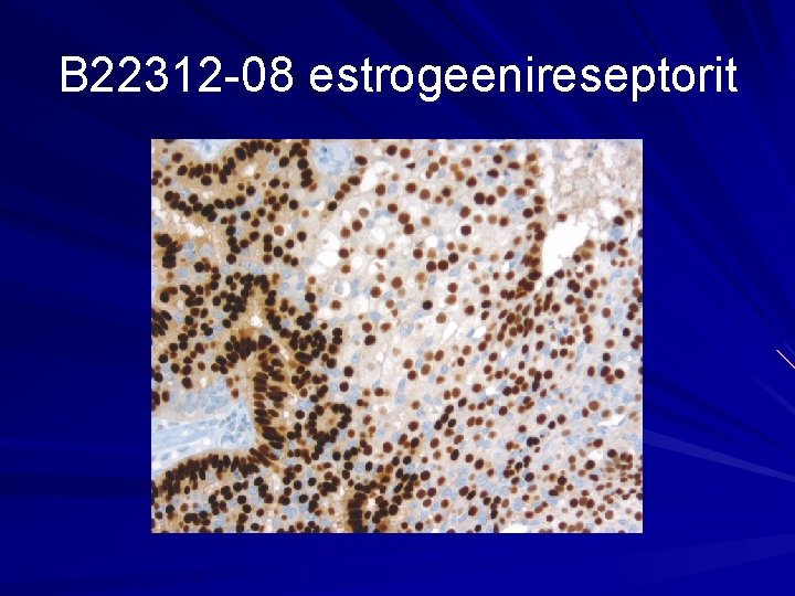 B 22312 -08 estrogeenireseptorit 