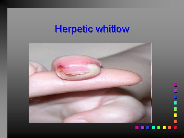 Herpetic whitlow 
