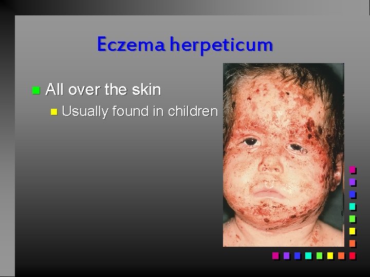 Eczema herpeticum n All over the skin n Usually found in children 