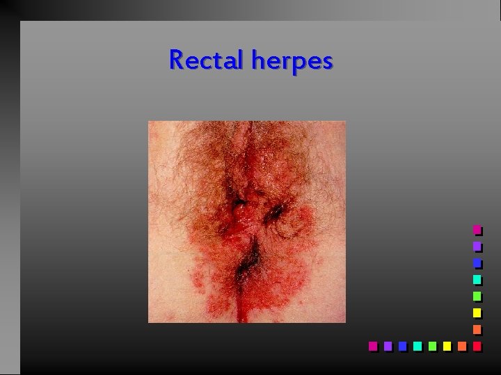 Rectal herpes 