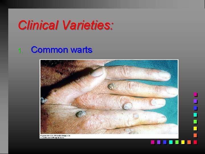 Clinical Varieties: 1. Common warts 