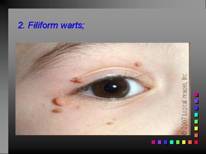 2. Filiform warts; 