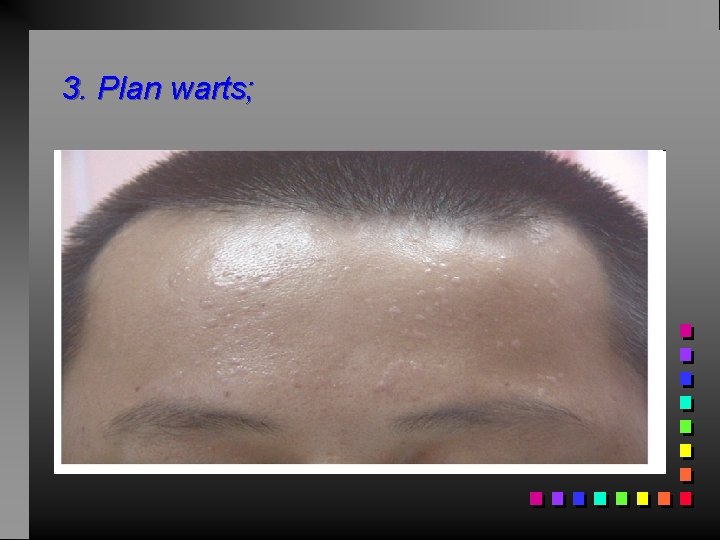 3. Plan warts; 