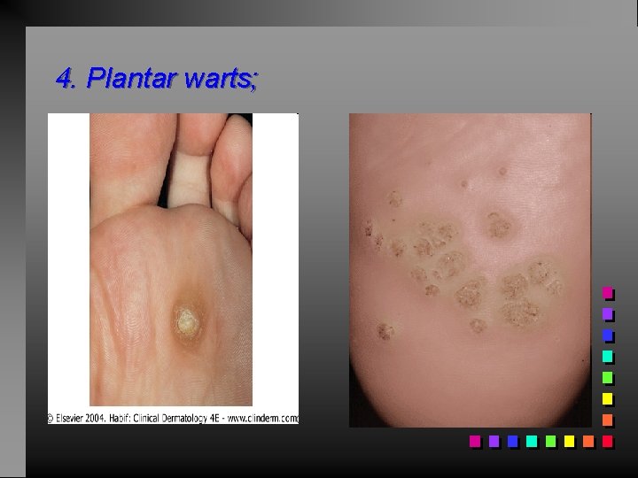 4. Plantar warts; 