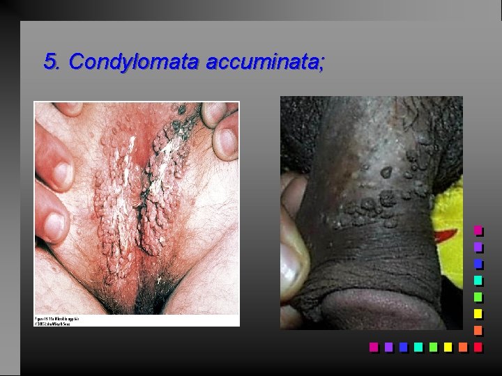 5. Condylomata accuminata; 
