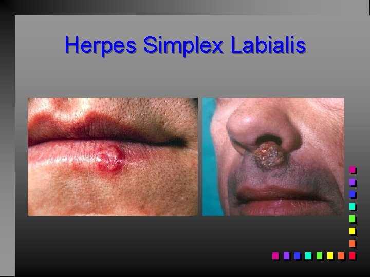 Herpes Simplex Labialis 