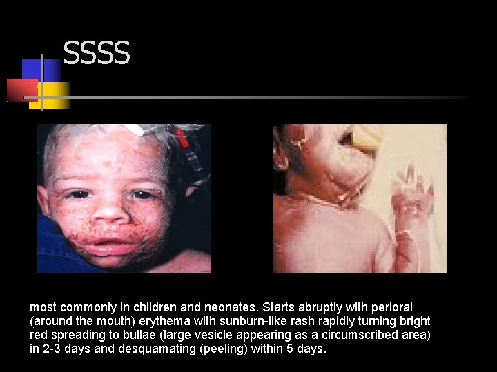 SSSS most commonly in children and neonates. Starts abruptly with perioral (around the mouth)