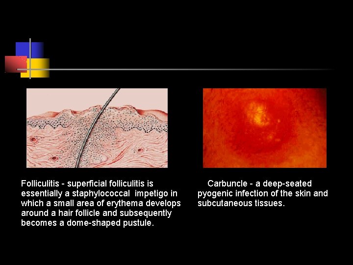 Folliculitis - superficial folliculitis is essentially a staphylococcal impetigo in which a small area