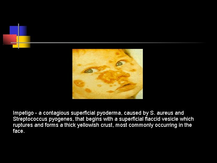 Impetigo - a contagious superficial pyoderma, caused by S. aureus and Streptococcus pyogenes, that
