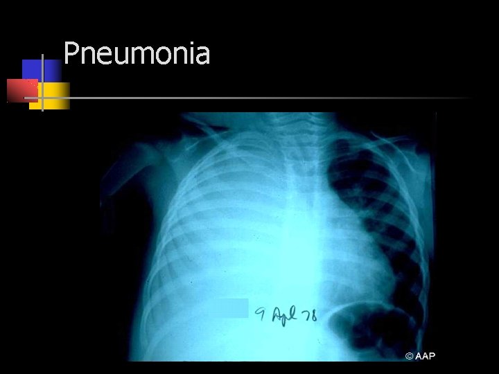 Pneumonia 