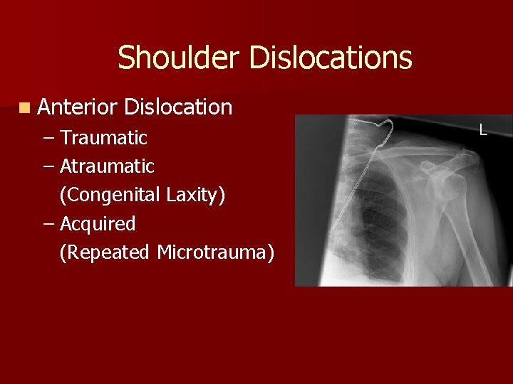 Shoulder Dislocations n Anterior Dislocation – Traumatic – Atraumatic (Congenital Laxity) – Acquired (Repeated