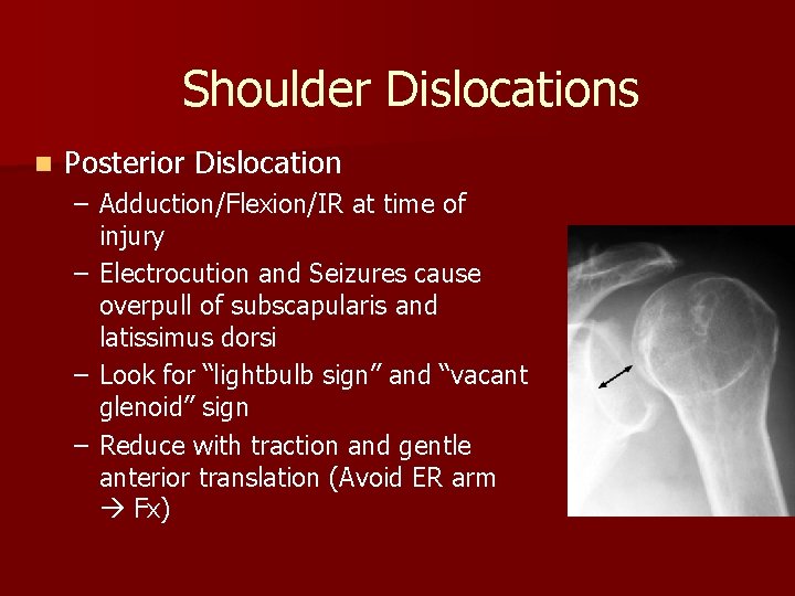 Shoulder Dislocations n Posterior Dislocation – Adduction/Flexion/IR at time of injury – Electrocution and