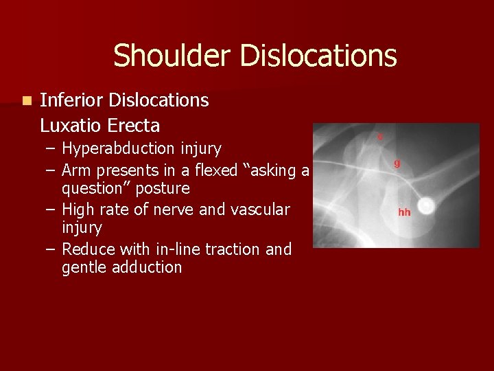 Shoulder Dislocations n Inferior Dislocations Luxatio Erecta – Hyperabduction injury – Arm presents in