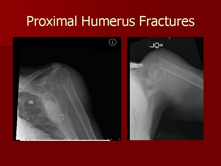 Proximal Humerus Fractures 