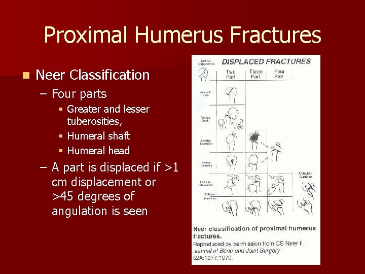 Proximal Humerus Fractures n Neer Classification – Four parts § Greater and lesser tuberosities,