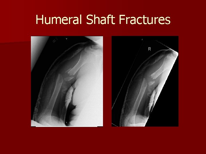 Humeral Shaft Fractures 