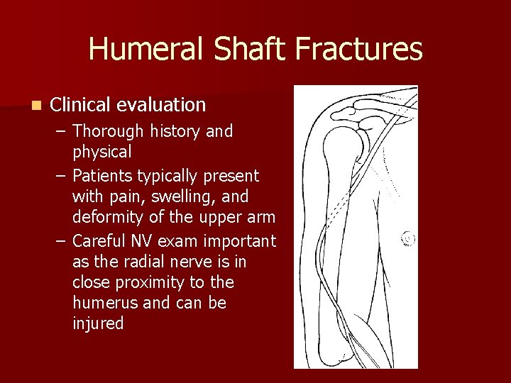 Humeral Shaft Fractures n Clinical evaluation – Thorough history and physical – Patients typically
