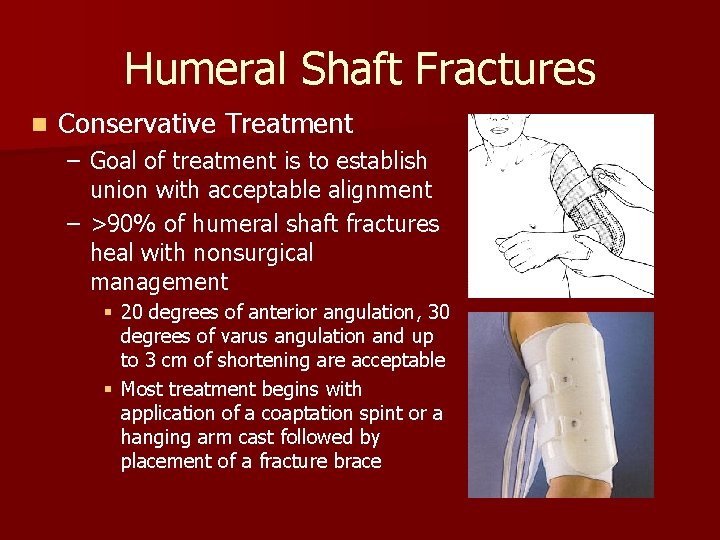 Humeral Shaft Fractures n Conservative Treatment – Goal of treatment is to establish union