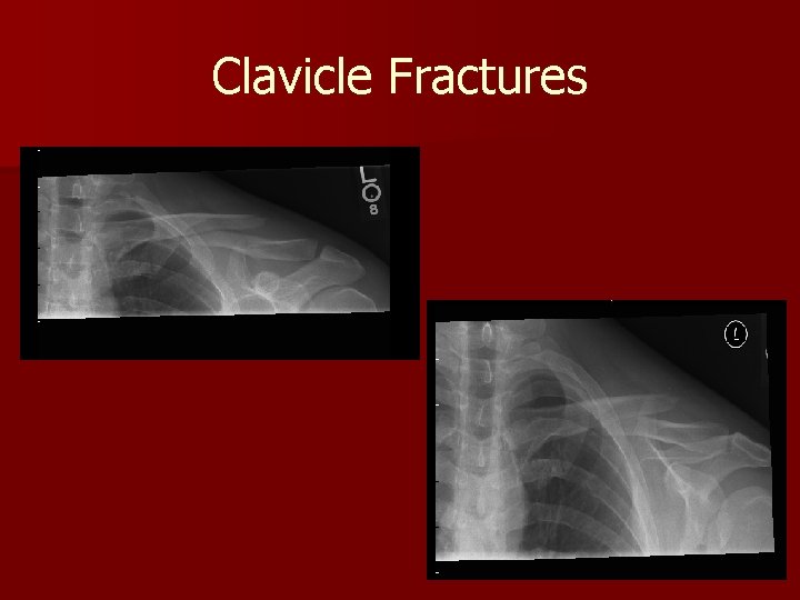 Clavicle Fractures 