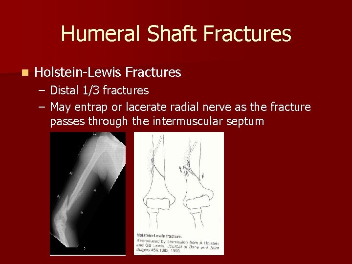 Humeral Shaft Fractures n Holstein-Lewis Fractures – Distal 1/3 fractures – May entrap or