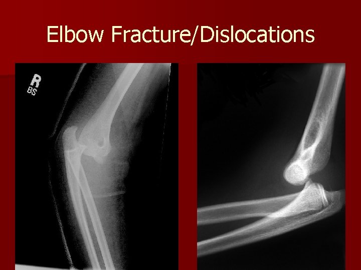 Elbow Fracture/Dislocations 