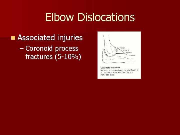 Elbow Dislocations n Associated injuries – Coronoid process fractures (5 -10%) 