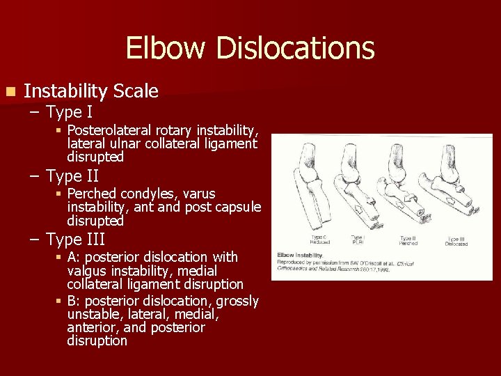 Elbow Dislocations n Instability Scale – Type I § Posterolateral rotary instability, lateral ulnar
