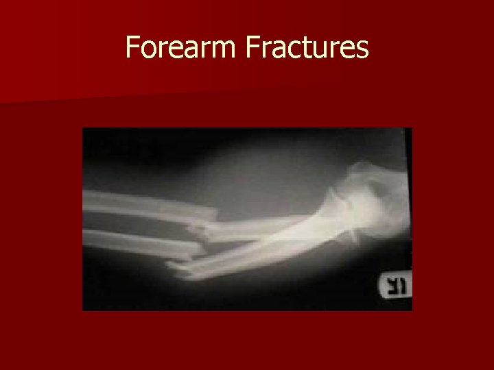Forearm Fractures 