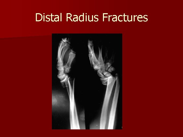 Distal Radius Fractures 