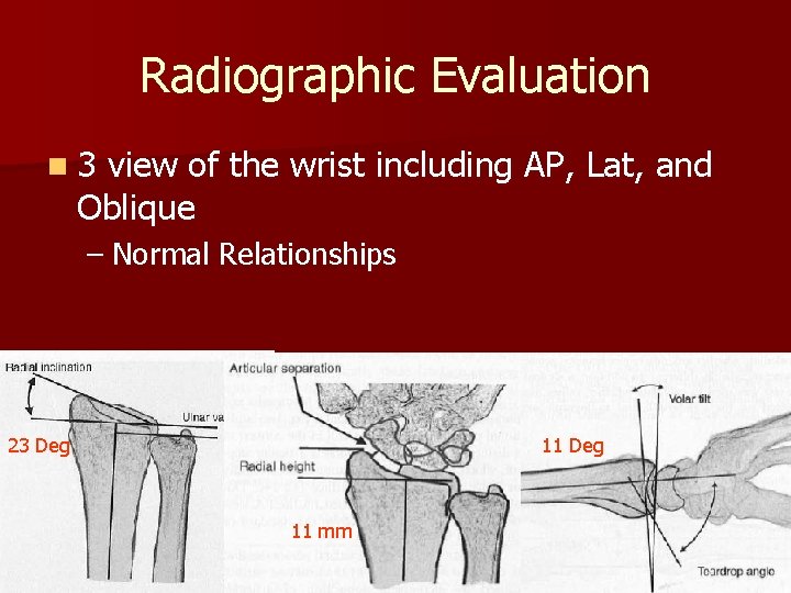 Radiographic Evaluation n 3 view of the wrist including AP, Lat, and Oblique –