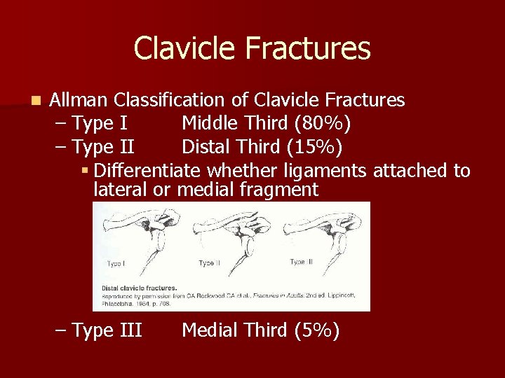 Clavicle Fractures n Allman Classification of Clavicle Fractures – Type I Middle Third (80%)