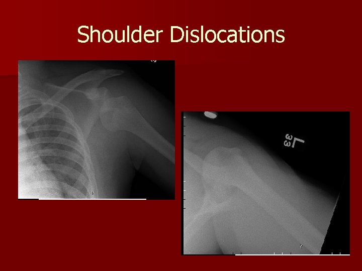 Shoulder Dislocations 