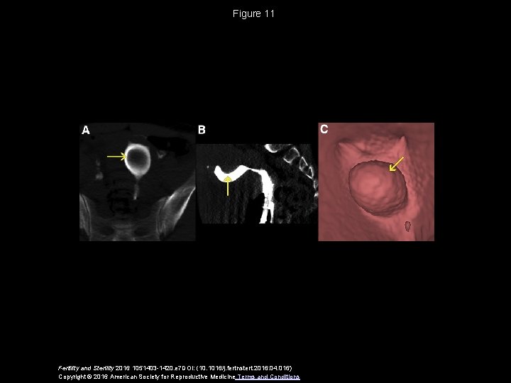 Figure 11 Fertility and Sterility 2016 1051403 -1420. e 7 DOI: (10. 1016/j. fertnstert.